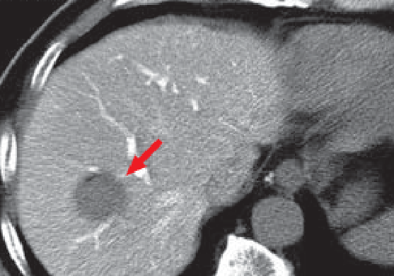 Legend: Angiographic CT