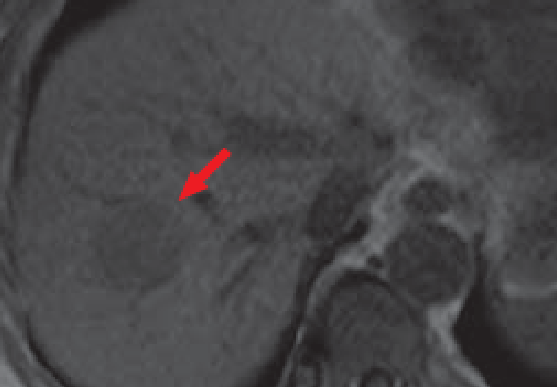 (c) Pre-contrast T1-weighted image