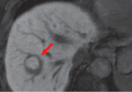 (e) Hepatobiliary phase