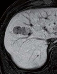 Hepatobiliary phase