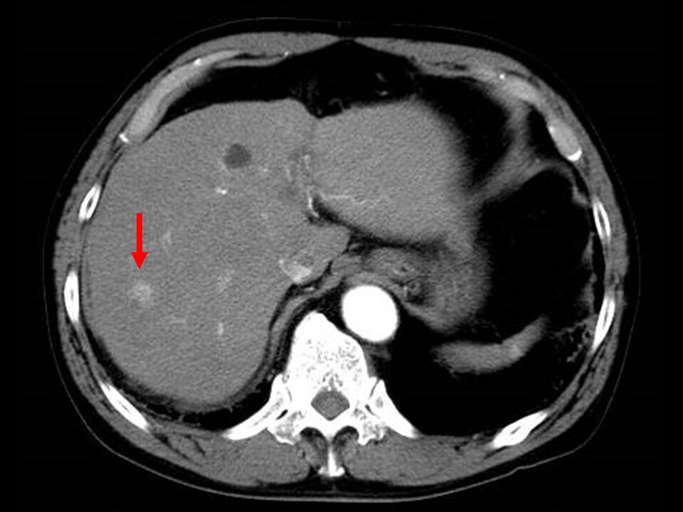 Fig. 3. Early phase of contrast CT