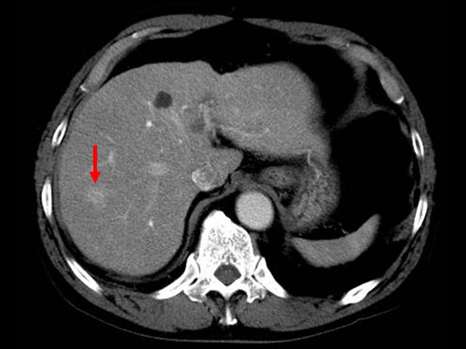 Fig. 4. Portal phase of contrast CT