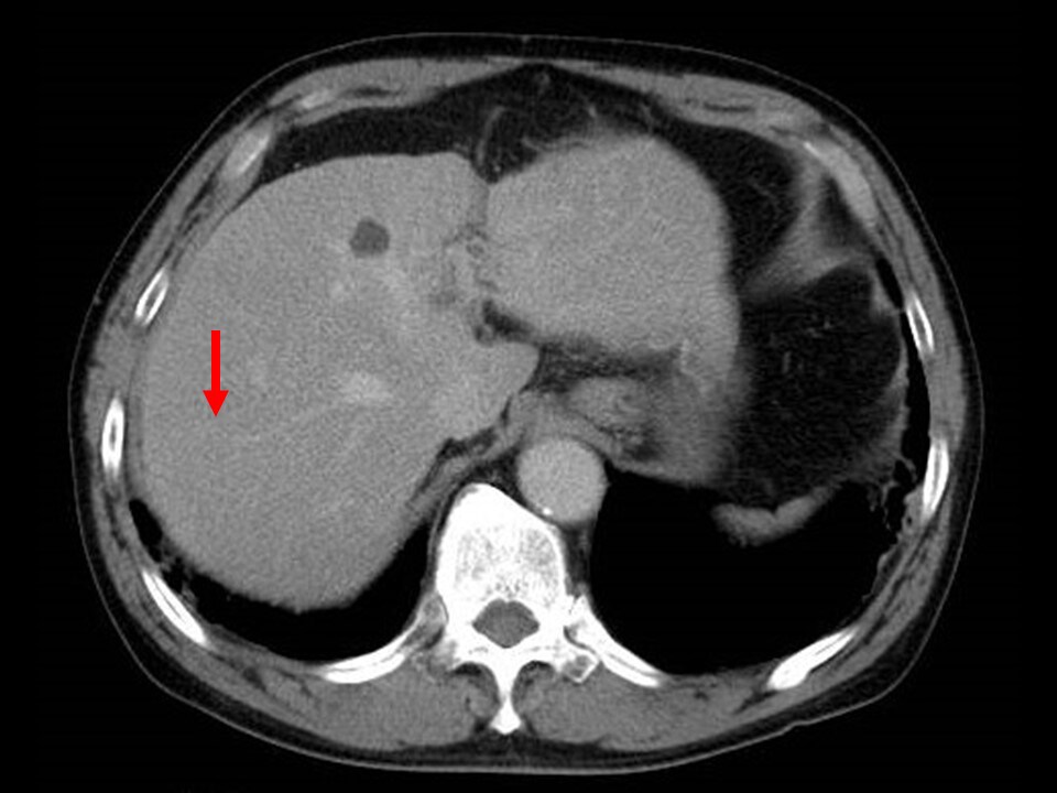 Fig. 5. Equilibrium phase of contrast CT