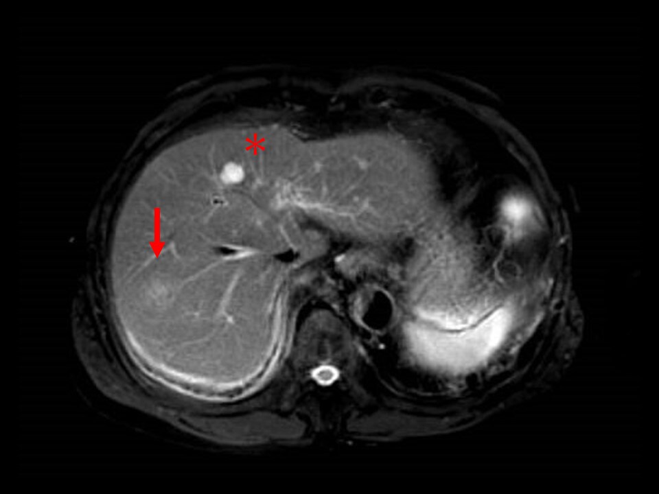 Fig. 6. MRI T2-weighted image