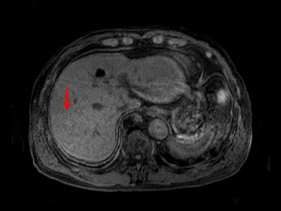 Fig. 7. T1-weighted image with simple MRI