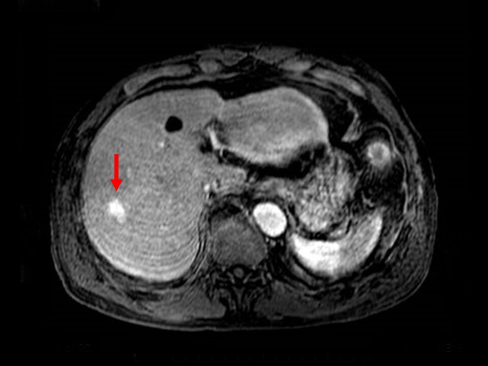 Fig. 8. T1-weighted image in MRI early phase