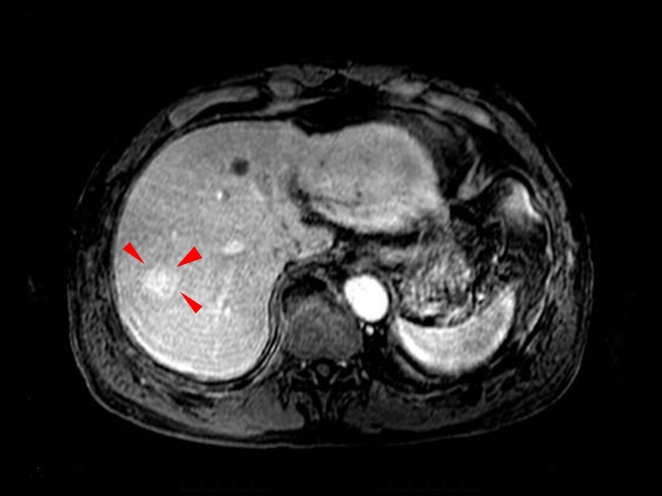 Fig. 9. T1-weighted image in MRI portal phase