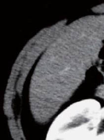 Contrast CT arterial phase