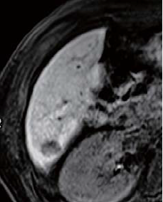 Hepatobiliary phase
