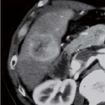 Contrast CT arterial phase