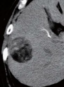 Contrast CT arterial phase