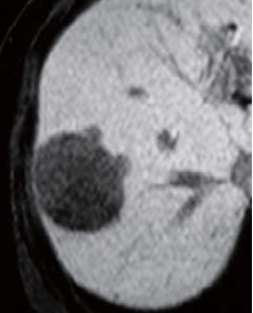 Hepatobiliary phase