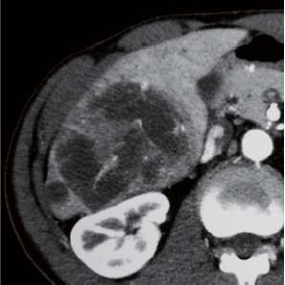Contrast CT arterial phase