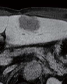 Hepatobiliary phase