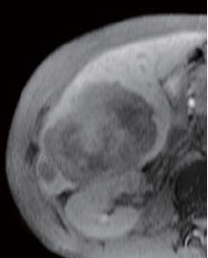 Hepatobiliary phase