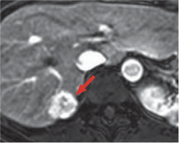 e) Arterial phase