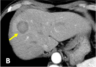 B: arterial phase