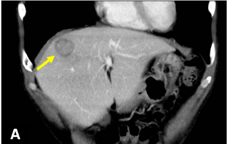 Fig. 2. CT coronal section (portal phase)