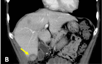 Fig. 2. CT coronal section (portal phase)