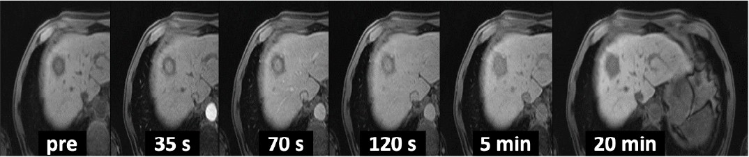 Fig. 3. EOB-MRI