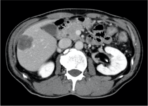 Fig. 1. S5 lesion, contrast CT equilibrium phase