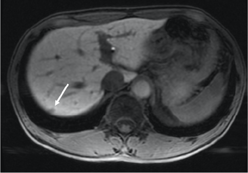 Fig. 4. Lesion below the S7 dome, EOB-MRI hepatobiliary phase