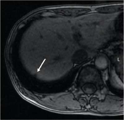 Fig. 6. Lesion below the S7 dome, opposed-phase