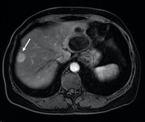 Fig. 3. Arterial phase of EOB-MRI