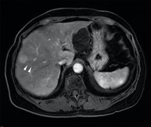 Fig. 4. Arterial phase of EOB-MRI