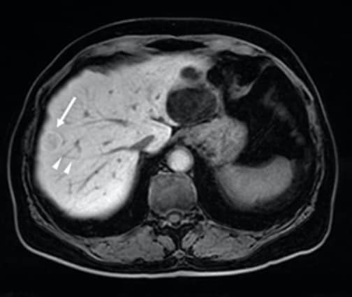 Fig. 5. Hepatobiliary phase of EOB-MRI