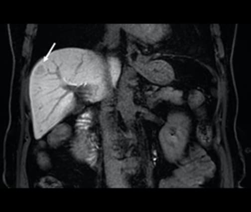 Fig. 6. Coronal section in hepatobiliary phase of EOB-MRI