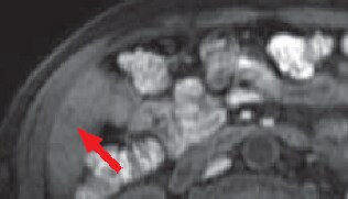 (e) Pre-contrast T1-weighted image