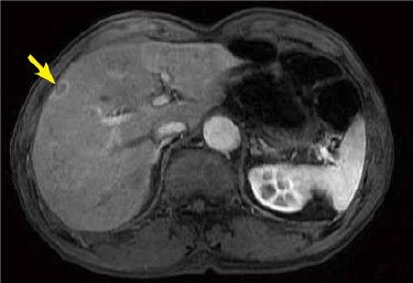 Arterial phase