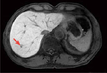 Hepatobiliary phase