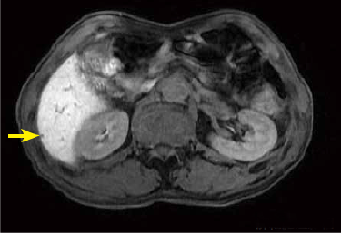 Hepatobiliary phase