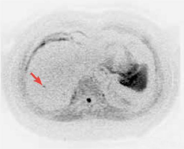Diffusion-weighted image
