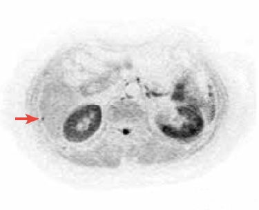 Diffusion-weighted image