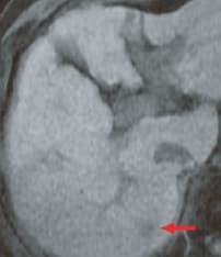 a) T1-weighted image