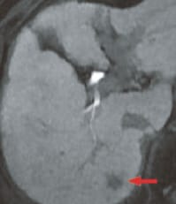 e) Hepatobiliary phase