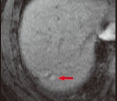 b) Arterial phase