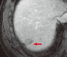 c) Portal phase