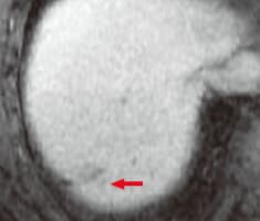 d) Late phase