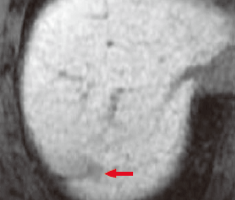 e) Hepatobiliary phase