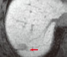 f) Different section in hepatobiliary phase (e)