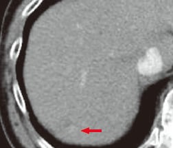 g) Arterial phase