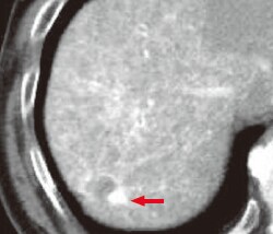 j) CT during hepatic arteriography