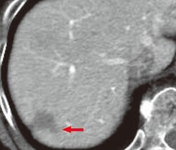 k) CT during arterial portography