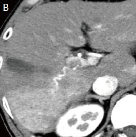Contrast CT images, arterial phase