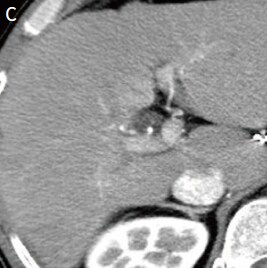 Contrast CT images, arterial phase