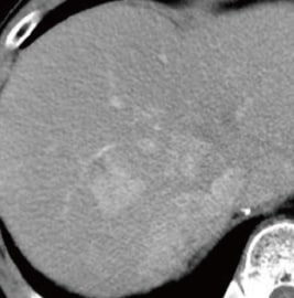 Contrast CT images, arterial phase